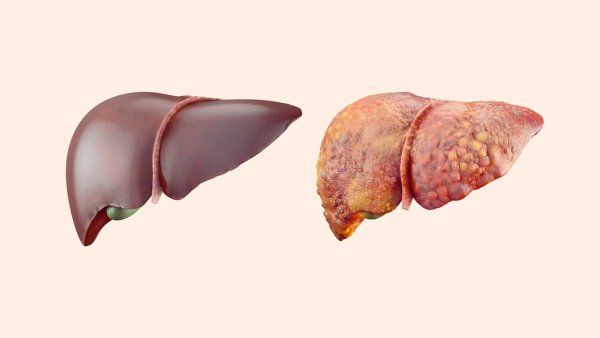 A photographic comparison showing a smooth, healthy liver, and a diseased liver.